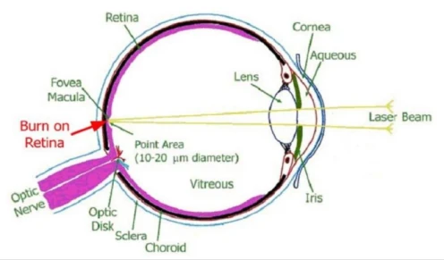 خطر آسیب به چشم توسط لیزر